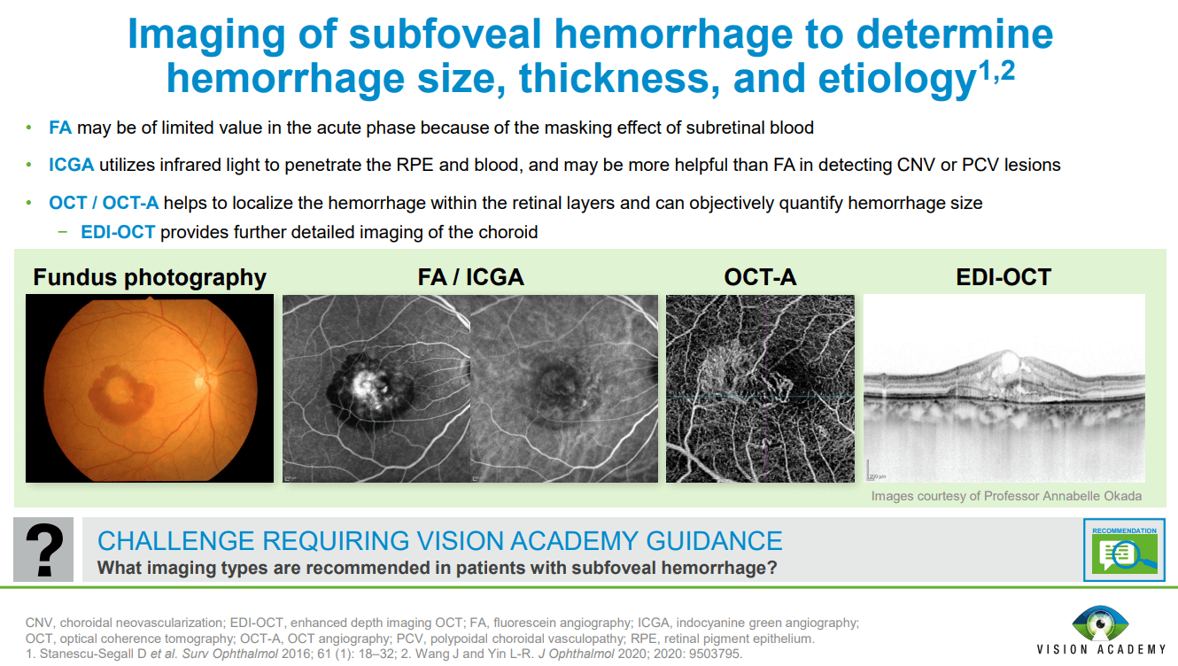 Management of subfoveal hemorrhage Management of subfoveal hemorrhage