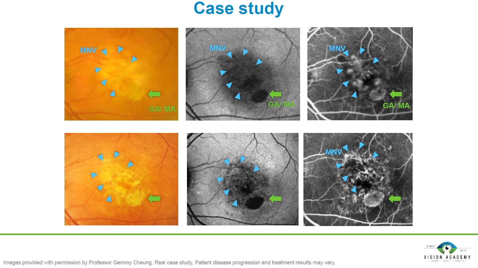 Simultaneous GA and CNV/MNV